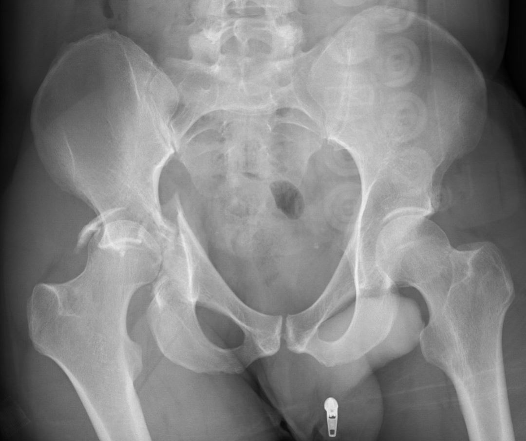 acetabulumfractuur.JPG