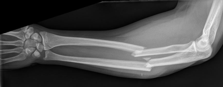 antebrachiumfractuur_0.JPG