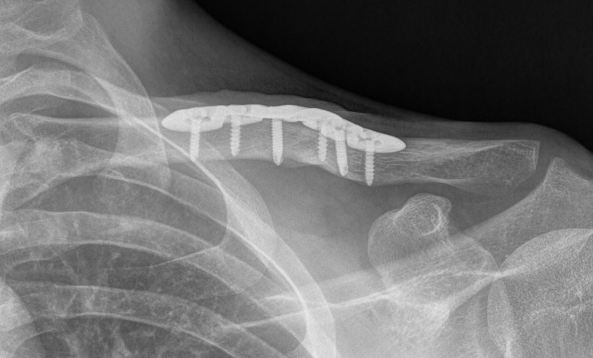 claviculaplaat.JPG
