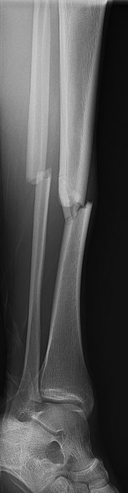 crurisfractuur.JPG