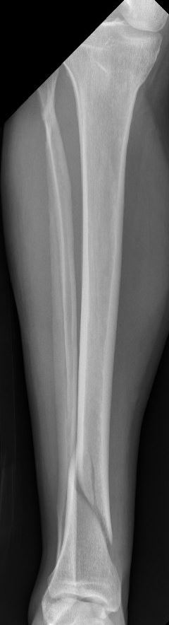 crurisfractuur2.JPG
