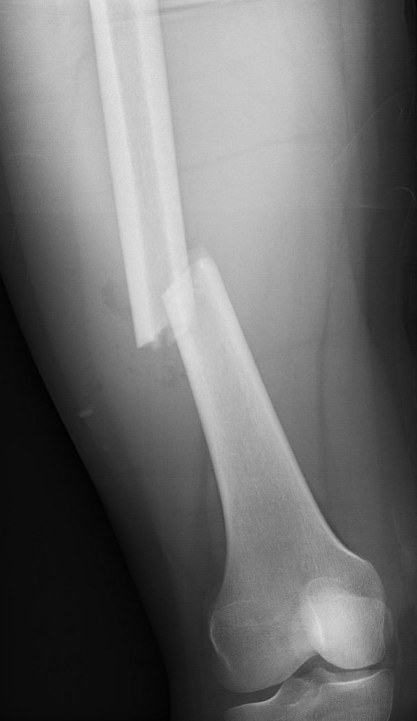 femurschachtfractuur.JPG