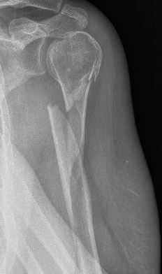 humersuproximaalfractuur.JPG