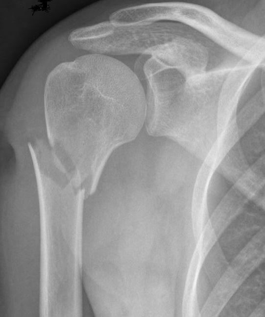humersuproximaalfractuur2.JPG