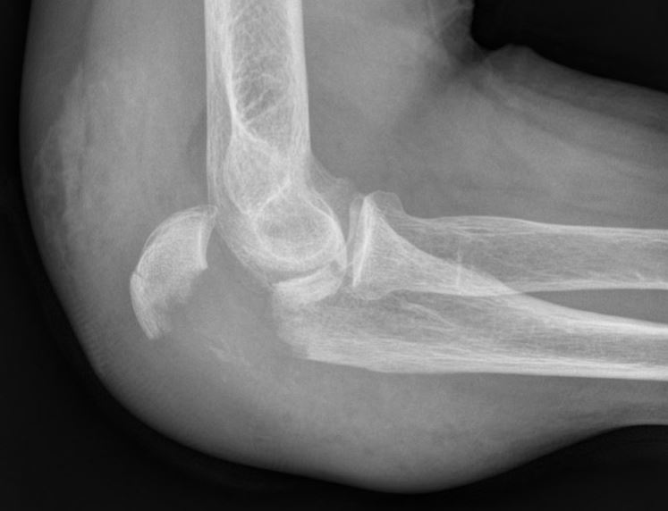 olecranonfractuur.JPG