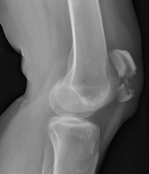 patellafractuur.JPG