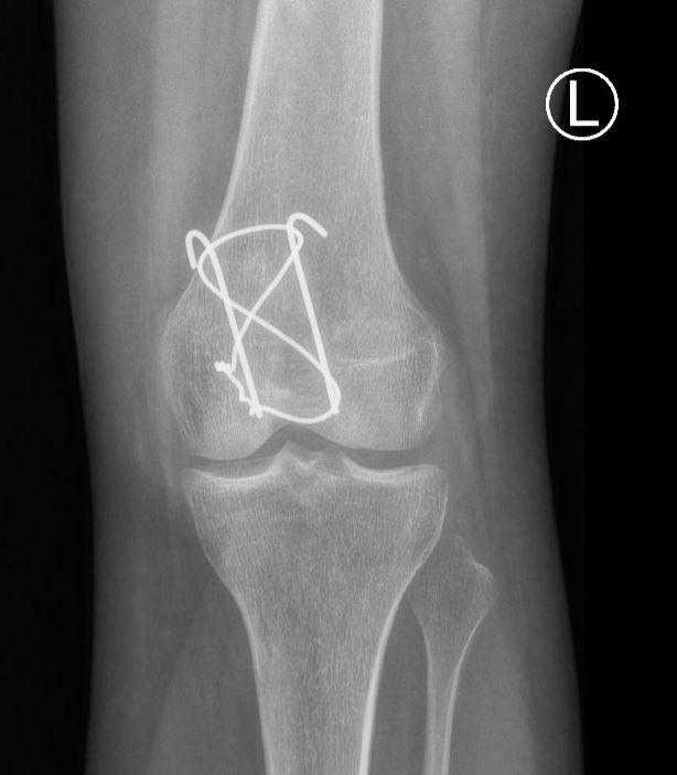 patellazuggurtungAP.JPG