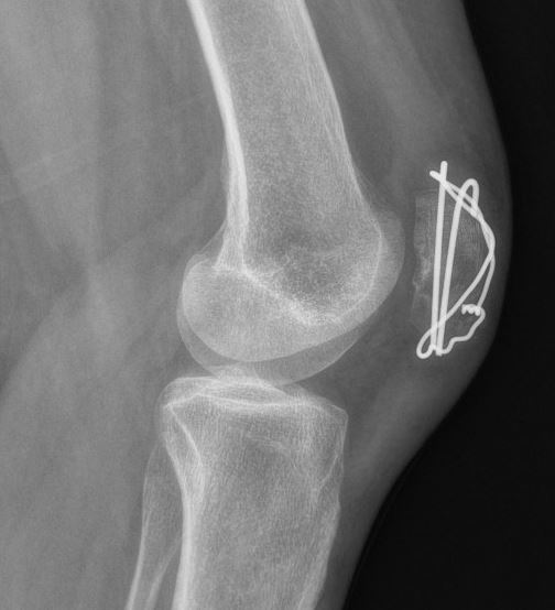 patellazuggurtungLat.JPG