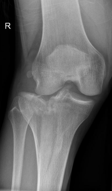 tibiaplateaufractuur.JPG