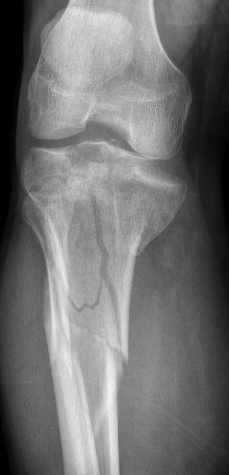 tibiaplateaufractuur3.JPG