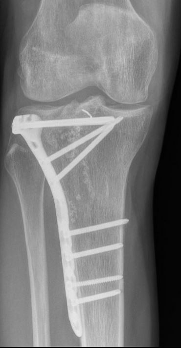 tibiaplateauplaat.JPG