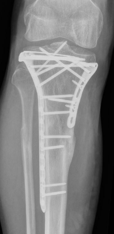 tibiaplateauplaat2.JPG